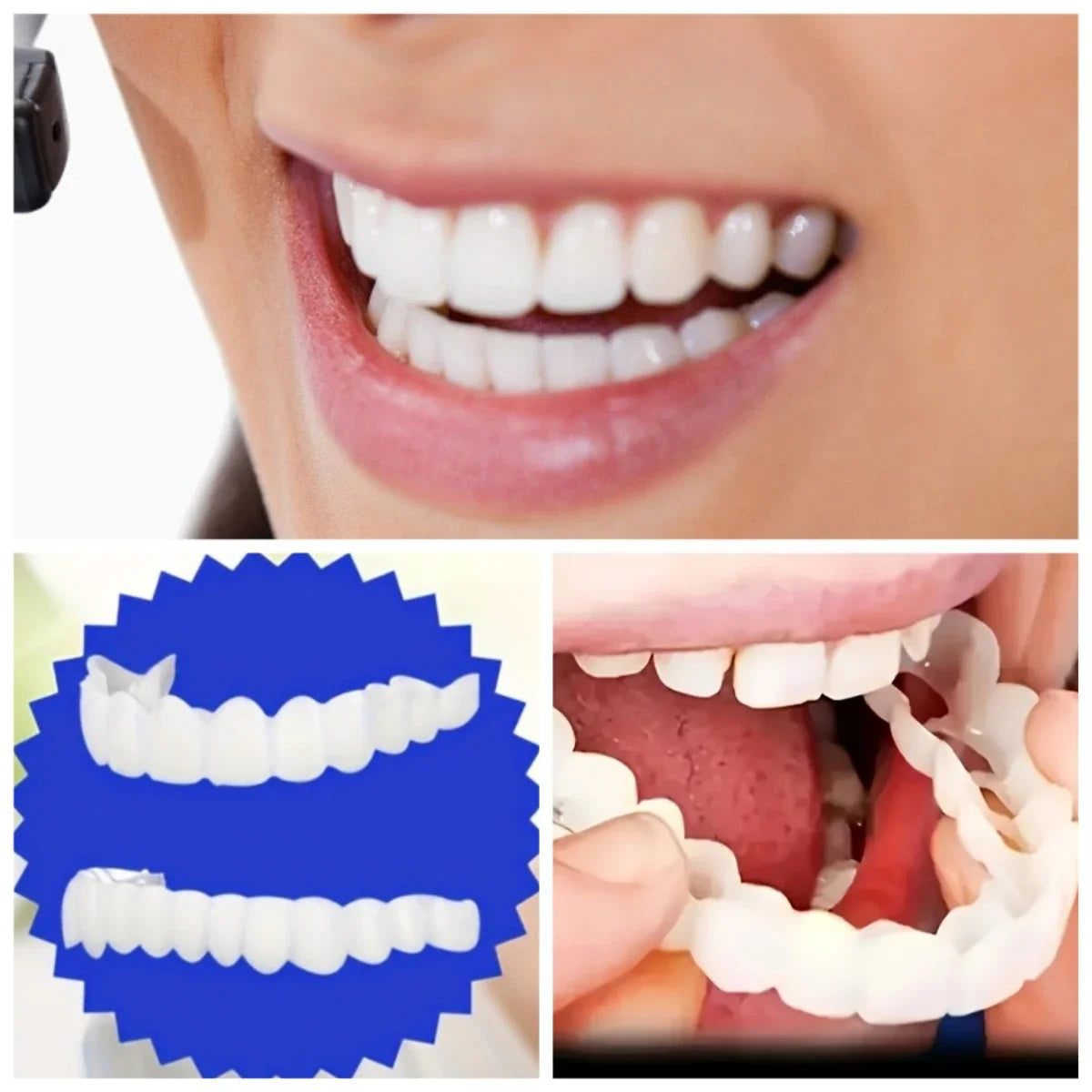 Snap in Veneers